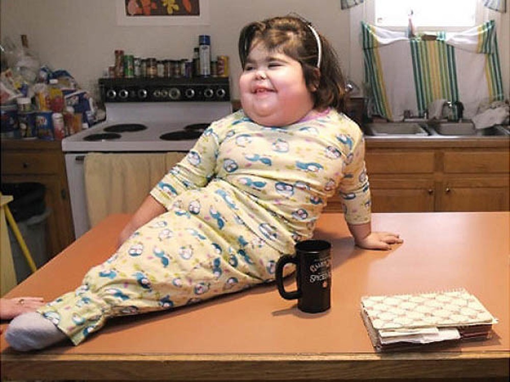 Hội chứng người cá - Hình ảnh minh họa